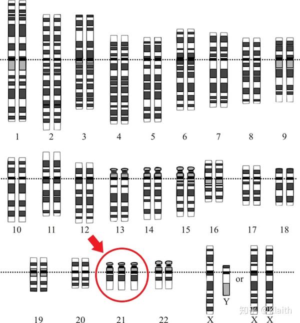 唐氏综合征患者的   条    号染色体(来源:en.wikipedia.org)