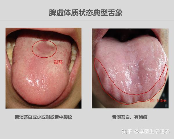 李医生的临床经验是以 舌脉象为主,以症状为辅判断脾虚最为准确.
