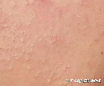 如果面部只有粉刺,无论是白头粉刺(闭合性粉刺,逆光疹)还是黑头粉刺