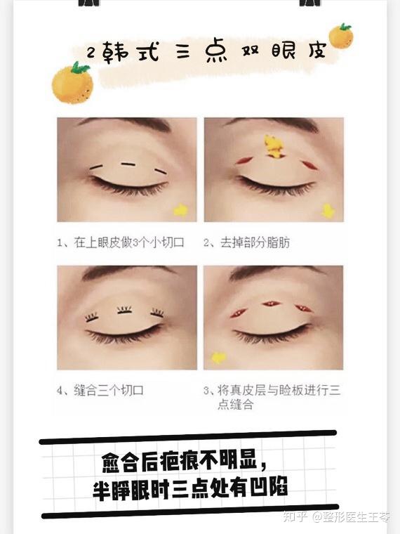 2韩式三点双眼皮