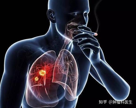 传染吗 专家介绍,肺癌患者一般是由于长期吸烟,遗传因素,肺部感染或者