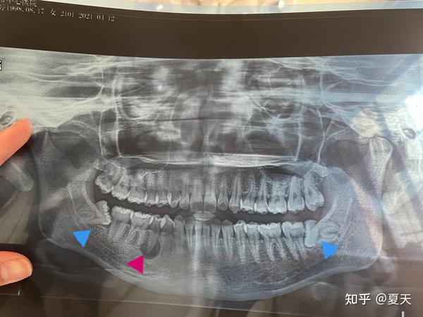 喜提四颗智齿!