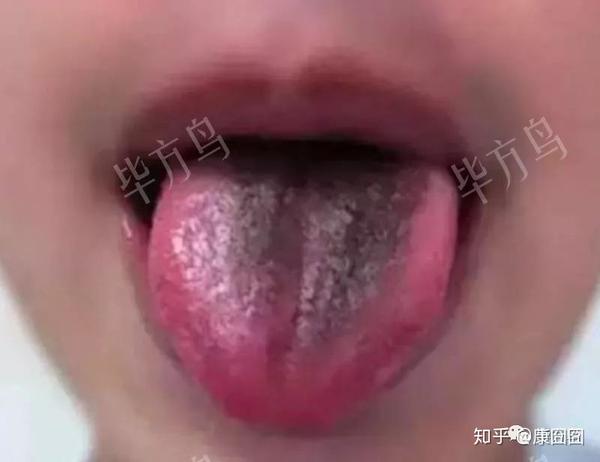 舌苔颜色发黑  舌头部分细胞坏死,大病或久病