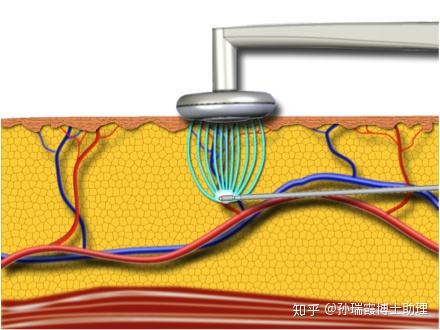 光纤溶脂射频溶脂吸脂项目那么多来看看它们之间有什么区别