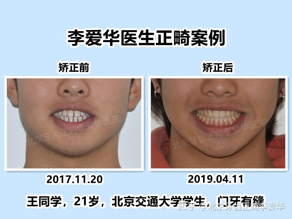 北京牙齿矫正门牙有缝隙案例