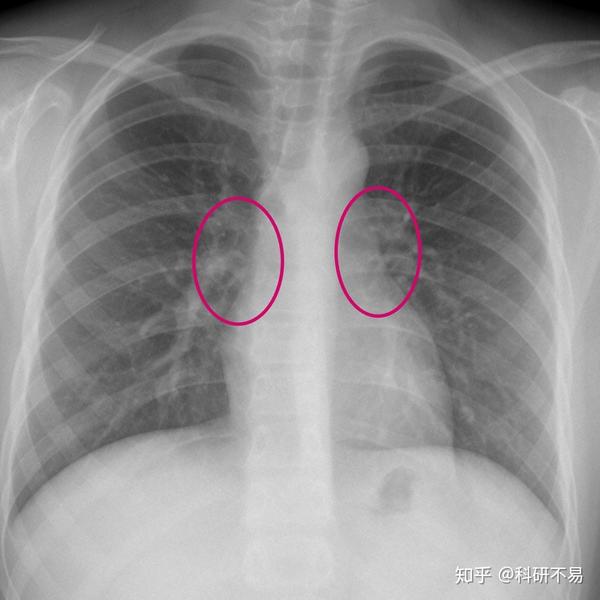 正常胸片(红色标注区为肺门)