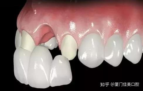 厦门牙齿修复丨牙齿贴面与全瓷牙你选哪个?