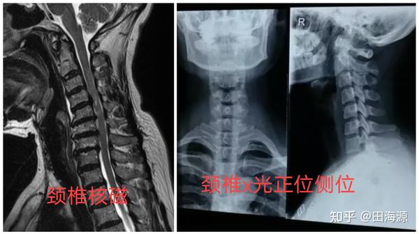颈椎核磁共振和 颈椎x光片正位侧位,除此之外,啥也不需要.