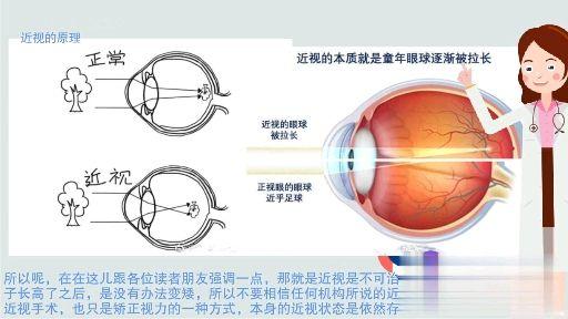 近视离焦原理视频