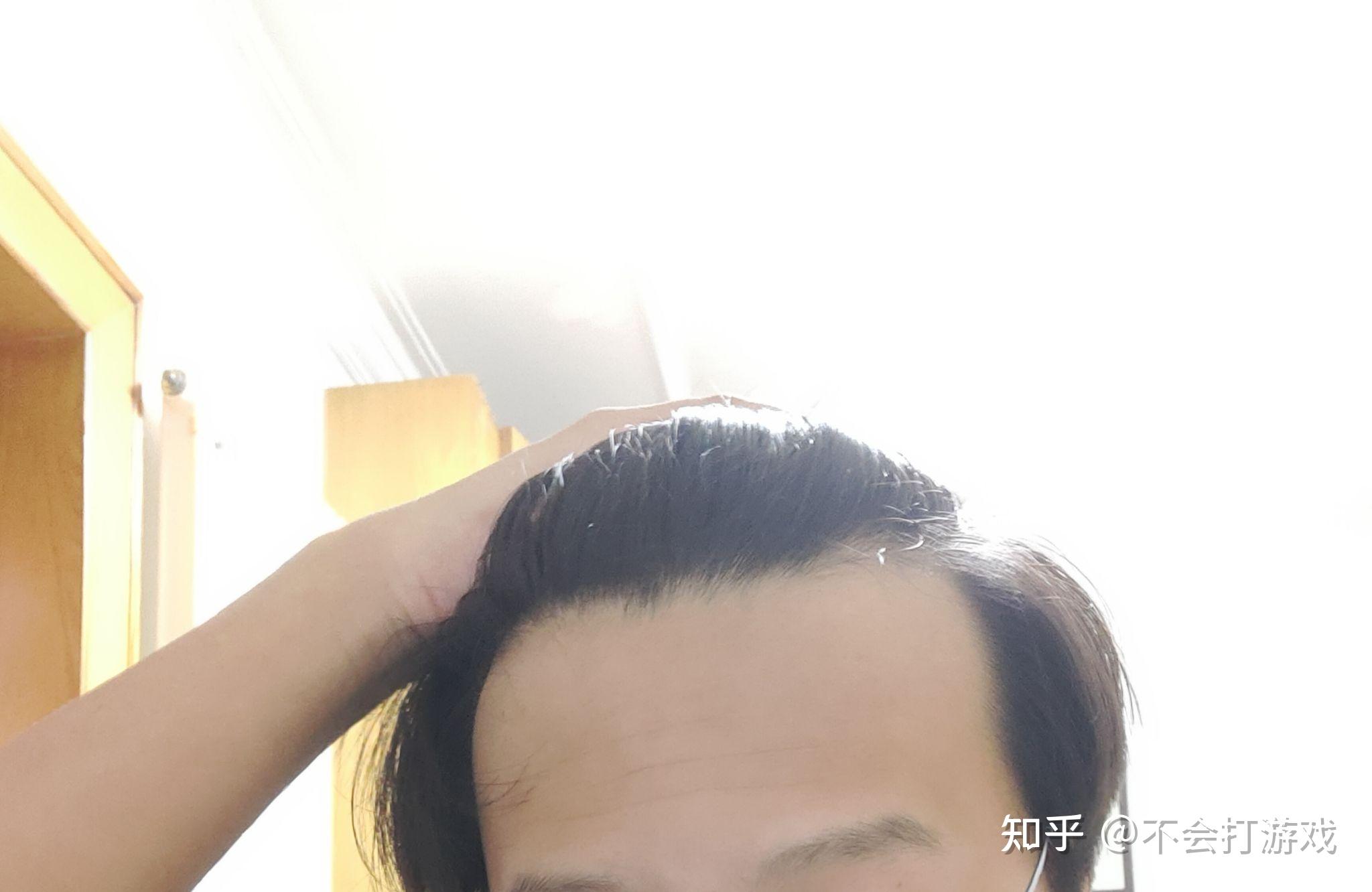 男生发际线高是一种什么样的体验