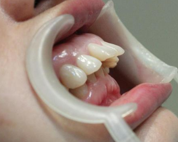 龅牙如何矫正?先来学会,如果判断自己是牙性还是骨性龅牙!