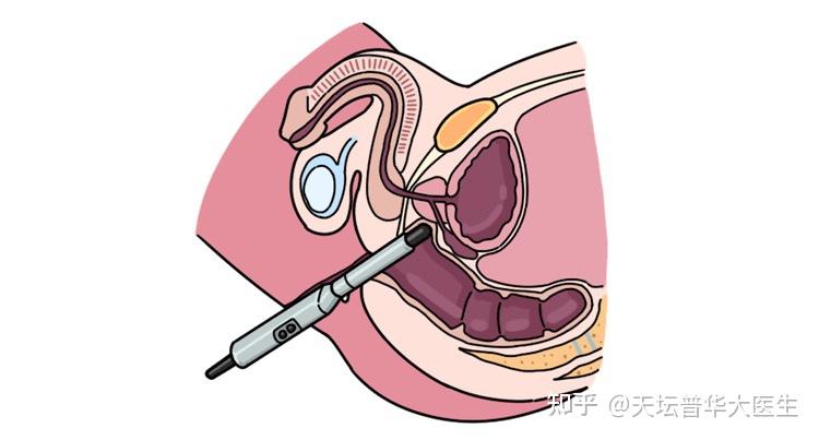 也可用来引导前列腺穿刺活检.