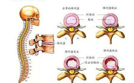 腰椎间盘突出?离不开这三个原因