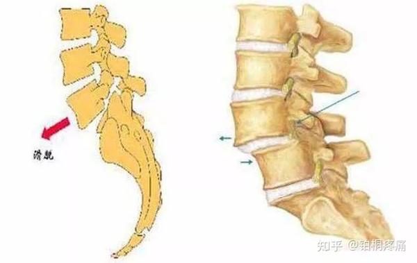 04,腰椎管狭窄症