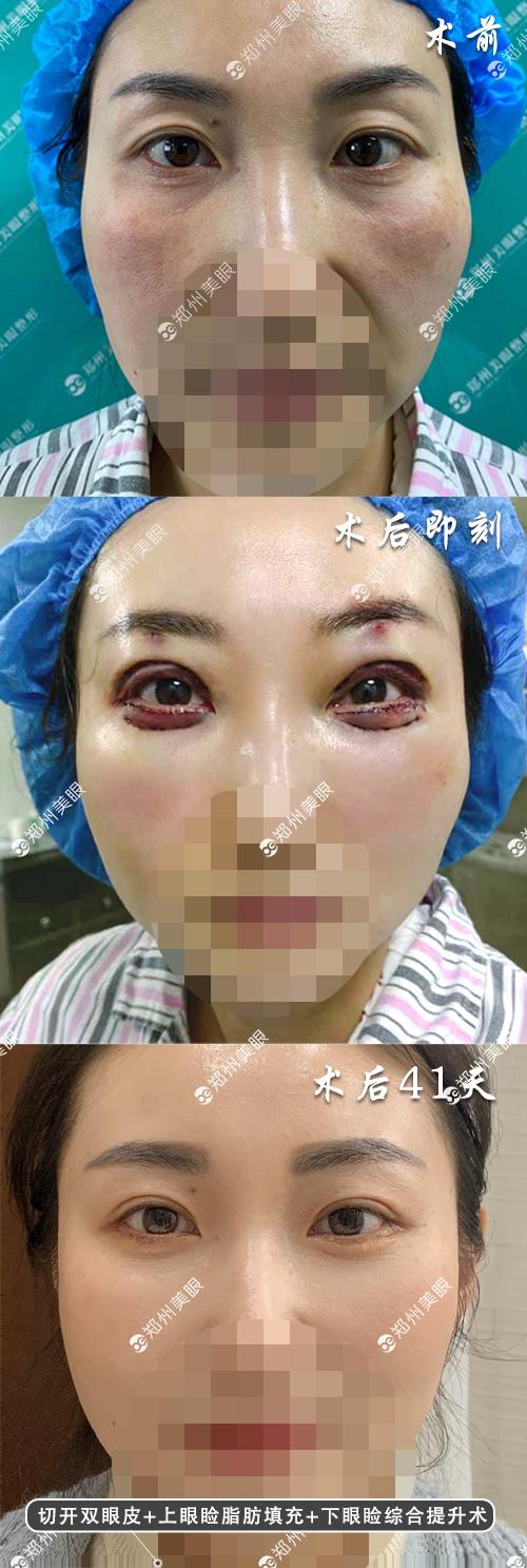 切开双眼皮77上眼睑脂肪填充77下眼睑综合提升术