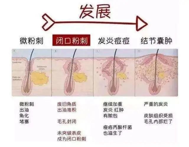 男生油痘肌不会选男士洗面奶看完这篇三分钟帮你全解决