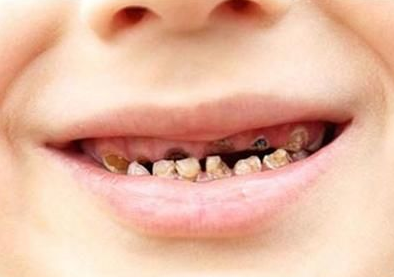儿童换牙期容易牙齿畸形吗?应多吃软食还是多啃"硬骨头"?