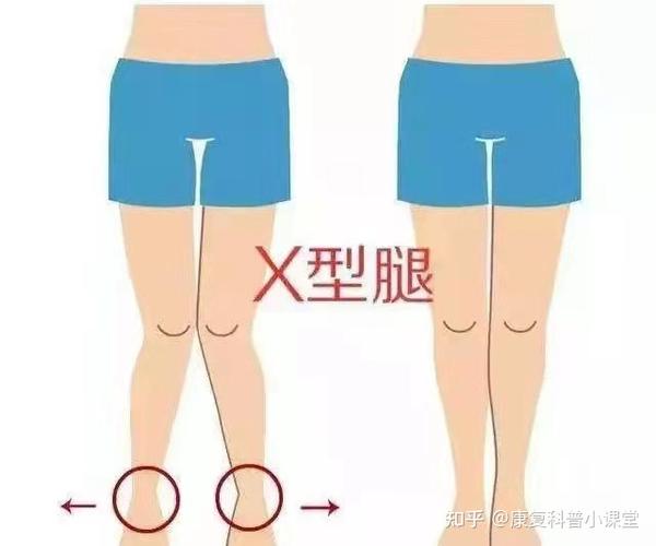 扁平足,"o"/"x"型腿?一张图带你自查体态问题(二)