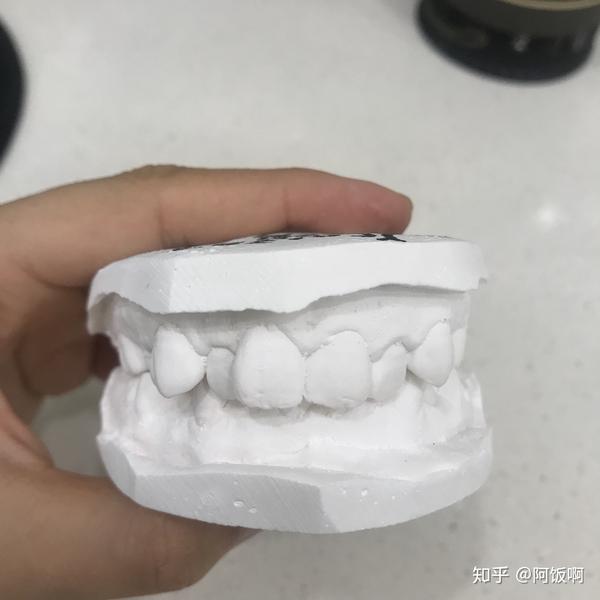 人物:女生 面世:95年12月 概况:有蛀牙龃齿,残根,其次是牙齿拥挤.