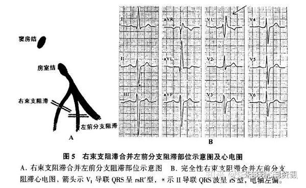 最常见为右束支阻滞合并左前分支阻滞(图5) ,这是因为二者在解剖上