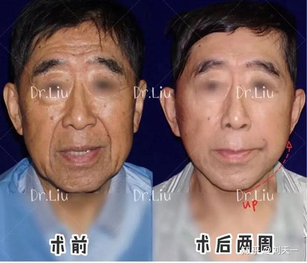 拉皮手术是具有改脸型的效果的,这在许多的手术案例中已经得到确定的