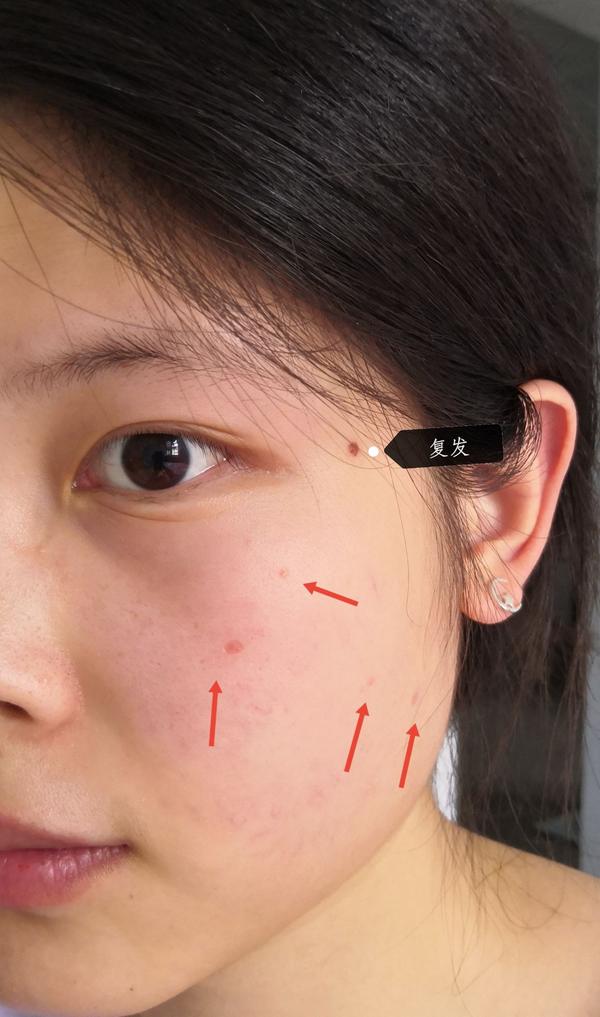 激光点痣恢复过程