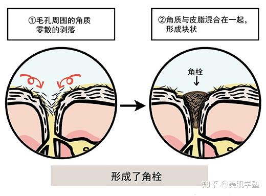 角栓是什么?鼻头毛孔里的白芯到底是什么?