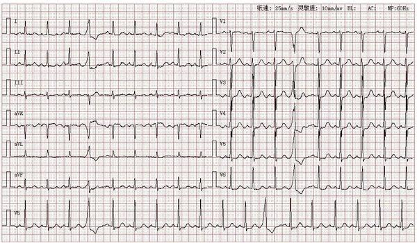 心电图图库室性早搏系列