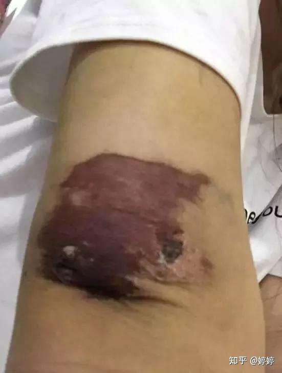 吸脂有什么后遗症