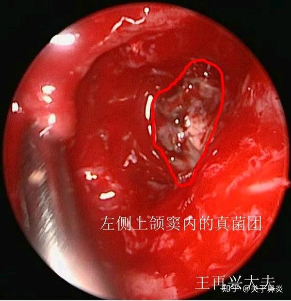 鼻腔散发腥臭味,有6种原因,尤其要当心是恶性肿瘤