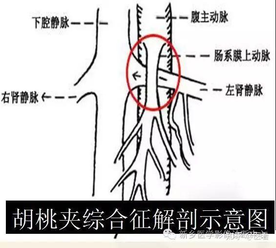 胡桃夹综合征(含后胡桃夹综合征)