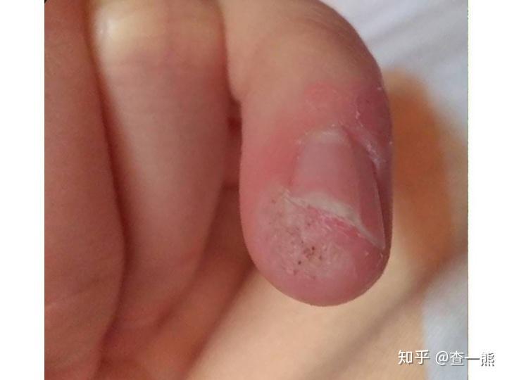 甲周疣一个小破口竟让跖疣病毒趁虚而入