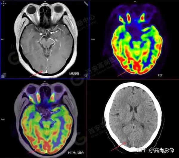 西安高尚医学影像诊断中心特色技术:pet/ct-mr多模态显像