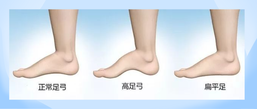 扁平足伤踝伤膝但足弓越高就越稳吗