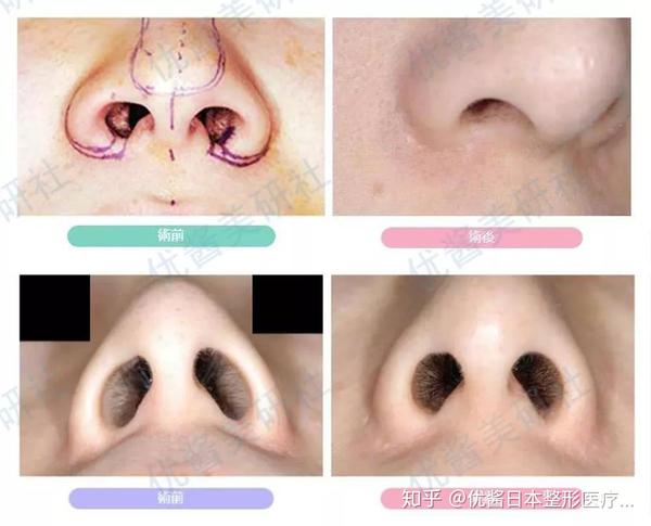 适用于鼻孔正常,但鼻翼比基部更外扩的人群.