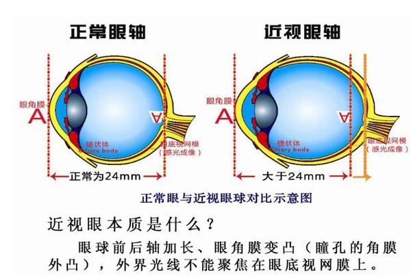 近视的眼轴与正常眼轴