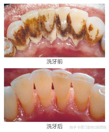 洗牙会伤害牙齿?三张图告诉你真相!