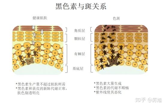 黑色素的多少,决定着我们的肤色,还有斑点,一旦黑色素如果在体内的