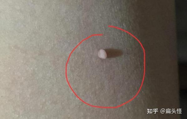 提醒女性若身体有2处发痒十有八九是hpv来了别以为是过敏