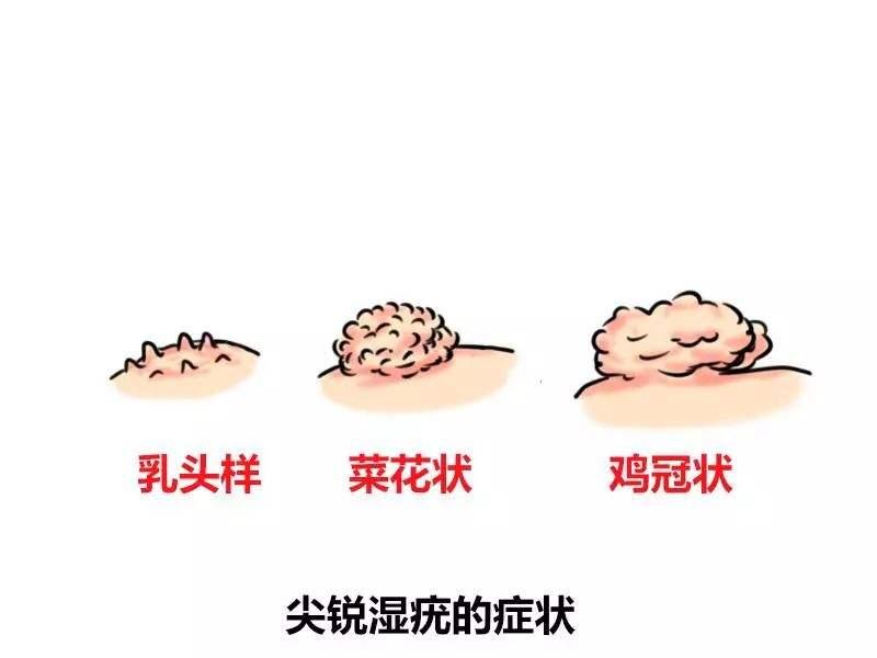 尖锐湿疣的早期症状