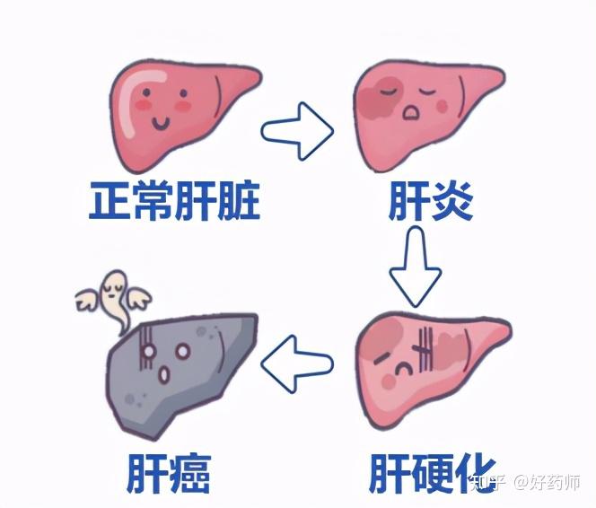 事实上,在我国肝癌患者中,80%以上由慢性乙肝病毒感染引起.