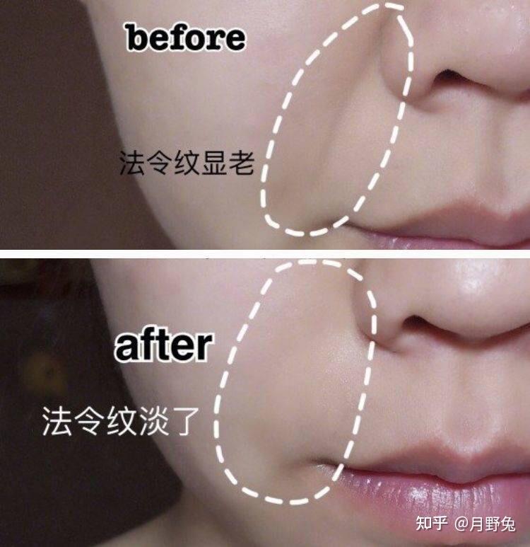 笑起来两边有括号是法令纹吗