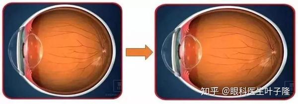 我们正常人的眼轴约为24mm,当近视出现时,眼轴则大于24mm,高度近视的