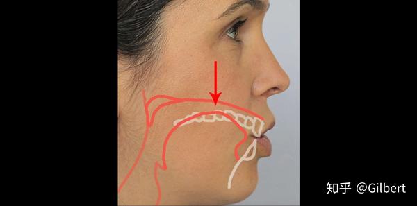第二种:舌尖不卷起,舌部中间顶住上颚,舌头两侧压住上牙两侧.