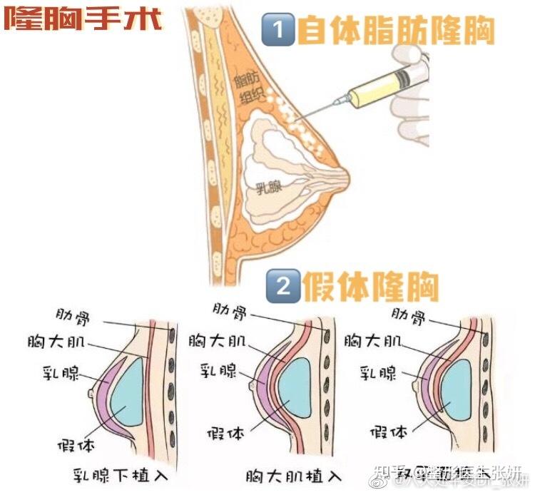 三种切口方式,腋下,乳晕,下皱襞,根据身体情况选择方式,适合人群广