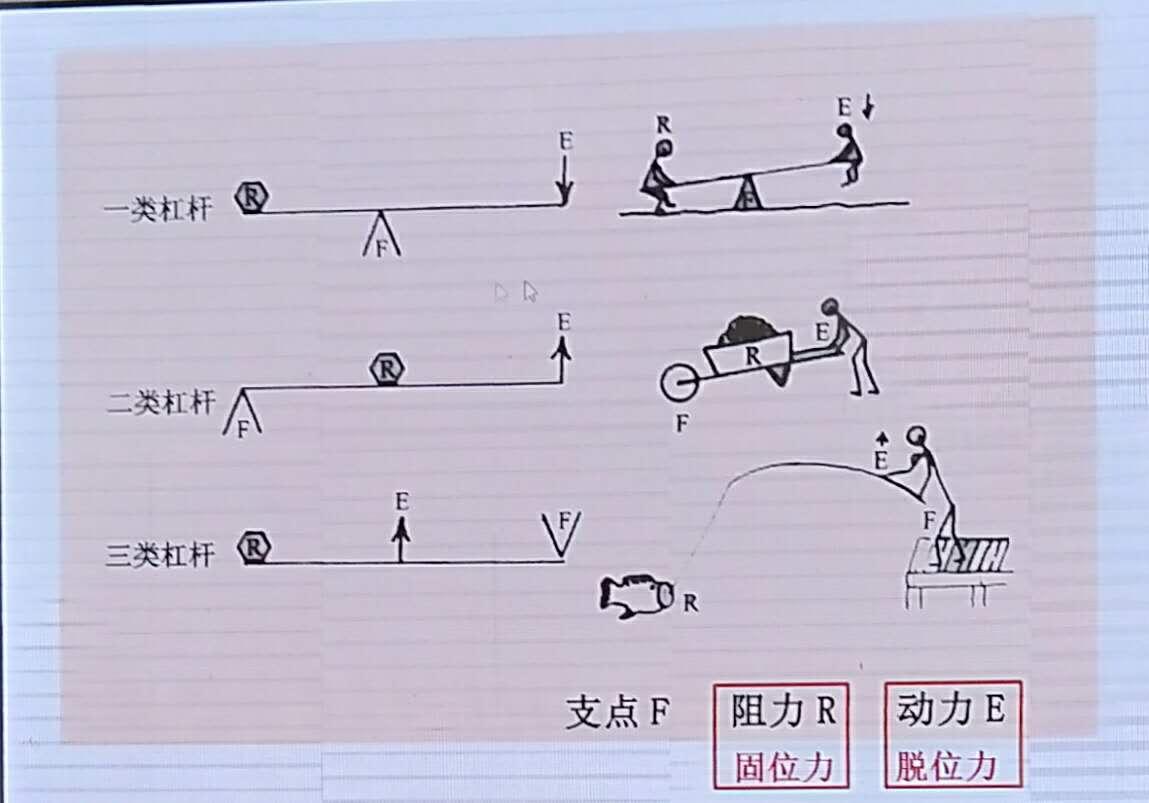 尽量选择二类杠杆:卡臂尖和游离端位于支点线的同侧!2,存在游离端,支