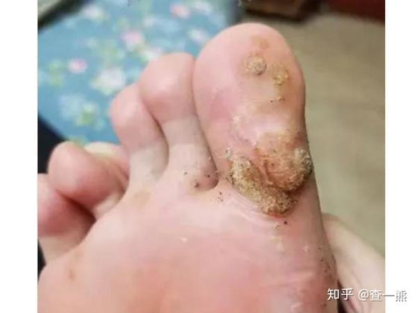 2月13号,第二次泡七味14天,不断修干净逐步发出的疣体,这时按压无痛感