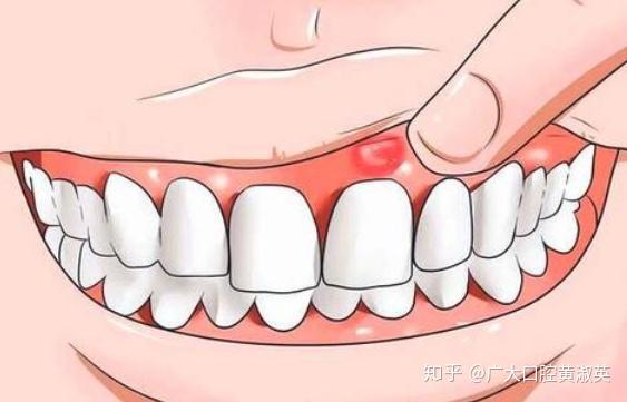 如何治疗牙龈脓包?