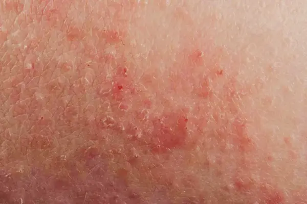 "湿疹性"指的是相应的一些症状,比如一定程度的脱屑,结痂或浆液渗出