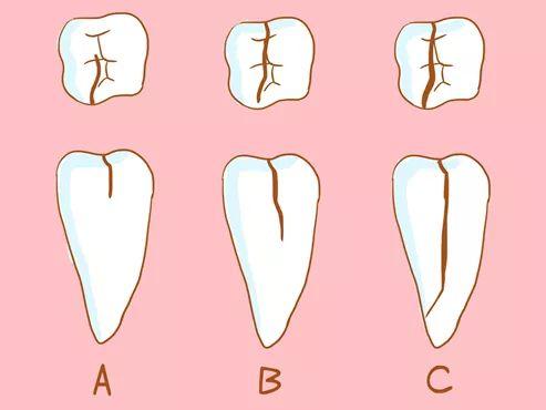其中,大家最常闻到对问题是:"牙齿为什么有裂缝?